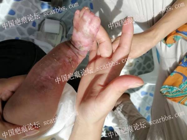 李高令2019年接治新生儿皮缺转大泡性表皮松懈症的孩子(安徽) 