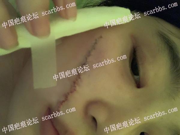 7.3日在陈立彬医生那里做的面部陈旧疤痕手术 
