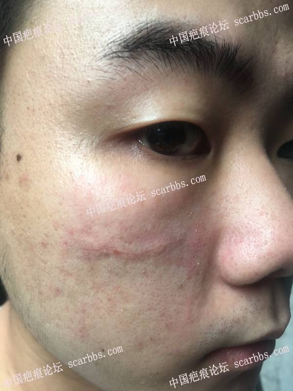 2019/5/30重庆杨东运教授切缝面部疤痕 