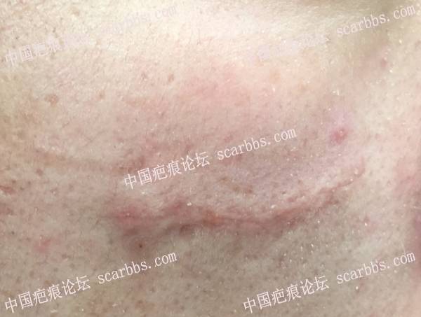 2019/5/30重庆杨东运教授切缝面部疤痕 