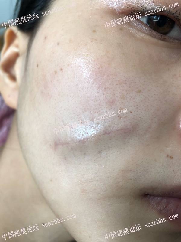 脸颊十多年的凹陷疤痕3.6日杨东运教授切缝 