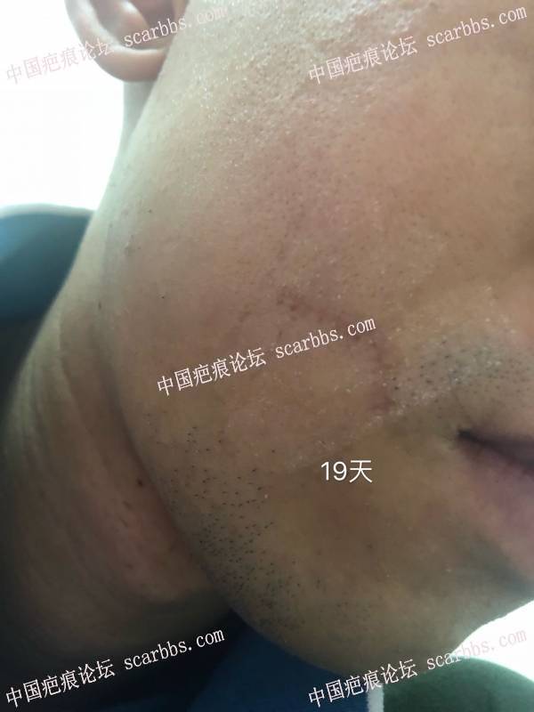 面部凹陷疤痕，广州中山三院（胡瑛）做的疤痕切缝手术 