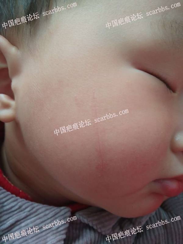 小孩脸上指甲划伤凹陷型疤痕，很深很明显 