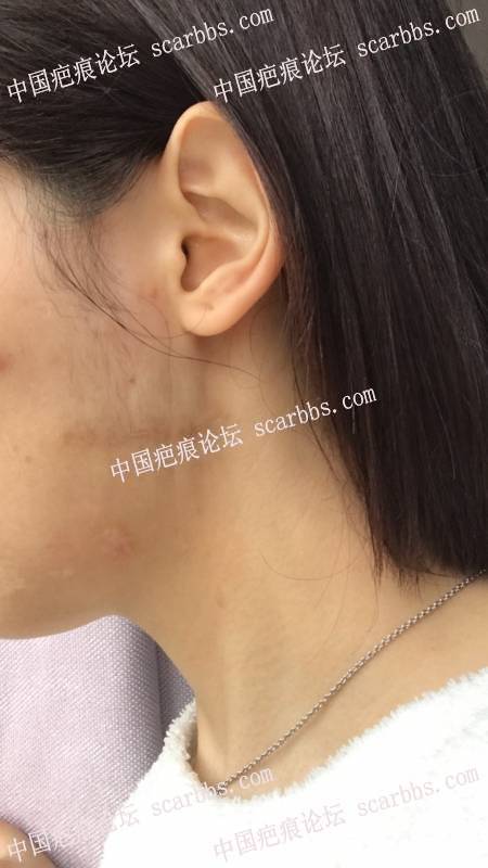 11月22号杨东运教授做的左脸疤痕切缝 