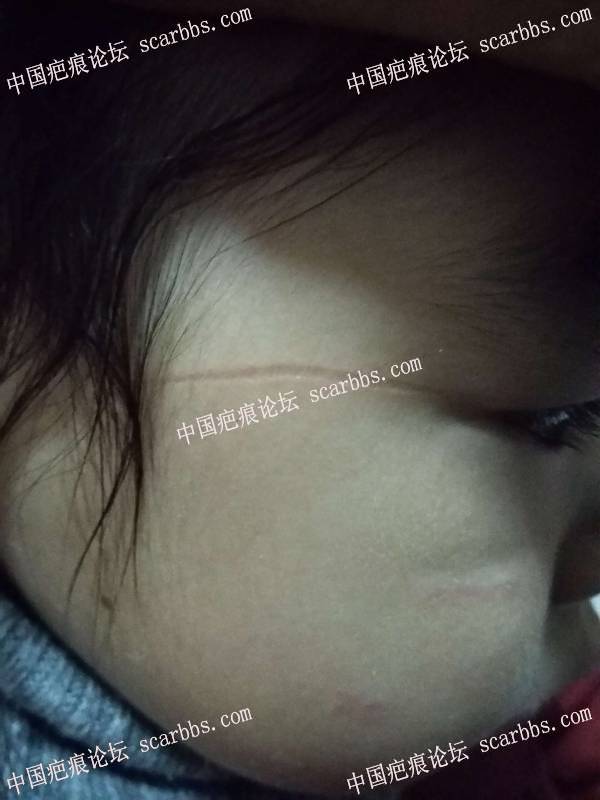 小孩脸上指甲划伤凹陷型疤痕，很深很明显 