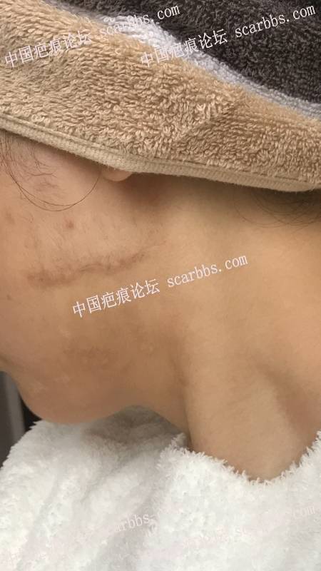 11月22号杨东运教授做的左脸疤痕切缝 