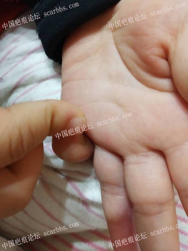 (李高令)五岁女孩被跑步机磨伤手指一个月(厦门) 