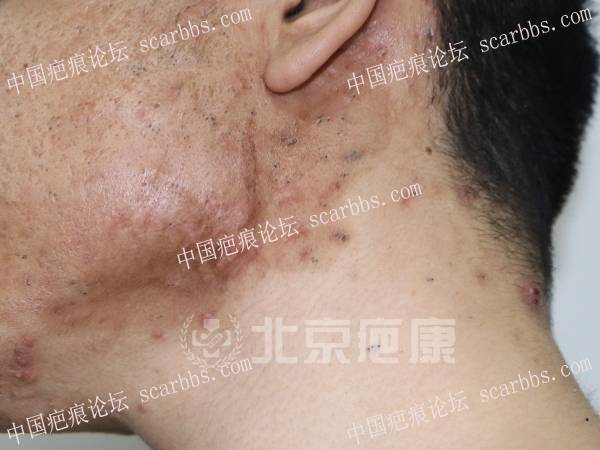 脸上长痘痘形成的疤痕疙瘩能治好吗？ 