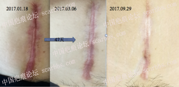 2017.3.6在四川华美紫馨打了疤痕针+光电治疗！ 疤痕,增生疤痕,剖腹产增生疤痕