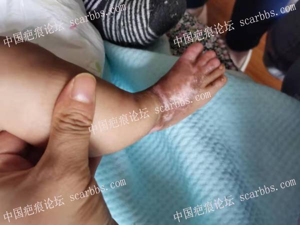 李高令2019年接治新生儿皮缺转大泡性表皮松懈症的孩子(安徽) 
