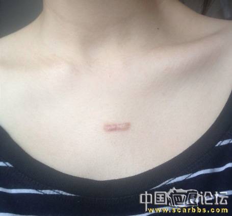 胸口长了一个疤痕疙瘩（十年了） 疤痕疙瘩,协和医院,北京,浙江,王友彬