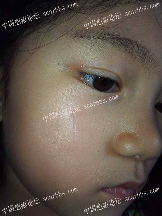 求助杨教授，6岁小女孩面部疤痕未缝合现变宽有什么方法补救？ 