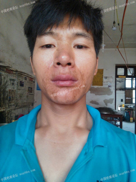访上海九院武晓莉：我们疤痕团队愿与您携手打造无疤人生 