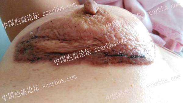 今天中医火针治疗胸部乳房下瘢痕疙瘩 胸部