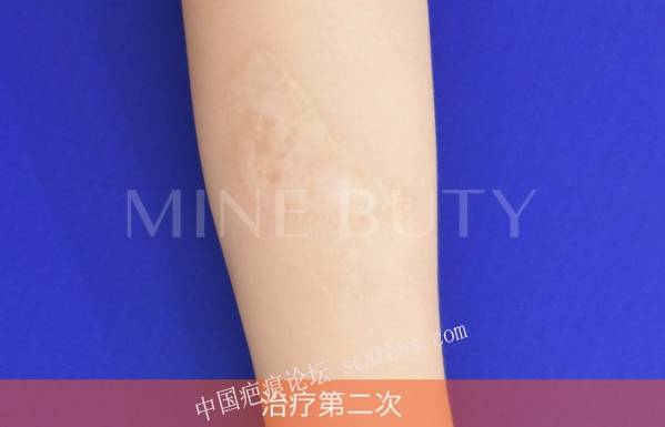 浅表性疤痕的治疗效果 疤痕,疤痕的治疗