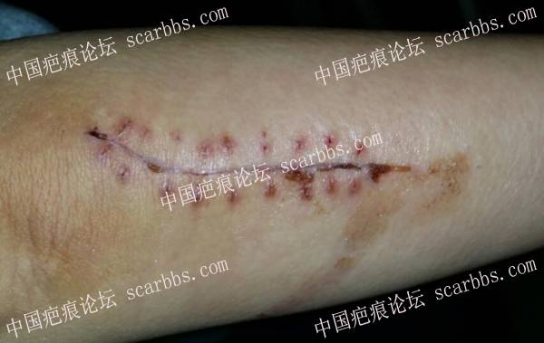 长达12cm的摔跤割伤疤痕护理日志 记录,整形外科,摔伤疤痕,割伤疤痕