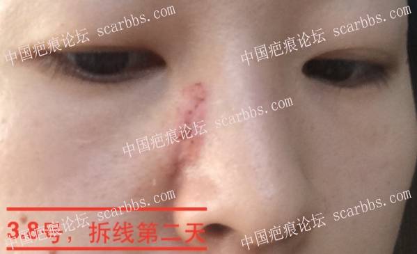面部十五年点痣疤痕武汉切缝修复详细记录 点痣疤痕,面部疤痕,手术切缝