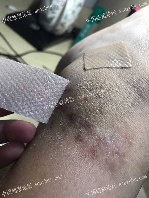 4月份的摔伤疤痕，记录我的祛疤过程 