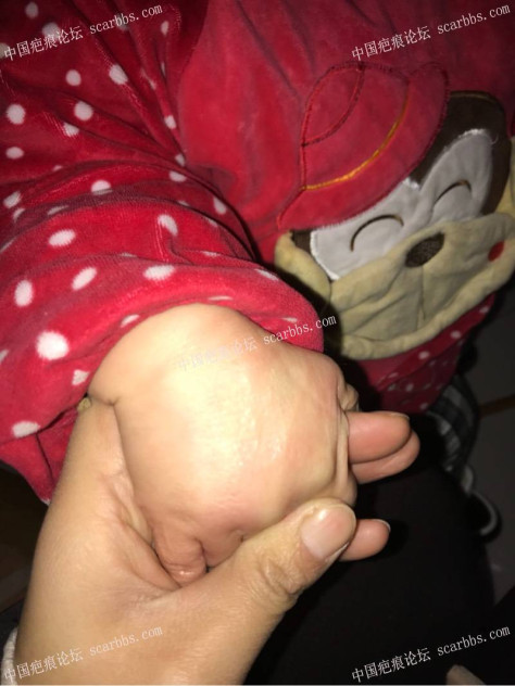 宝宝手指手背烫伤，抗疤26天，坚持下去！ 
