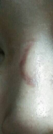 鼻梁皮瓣转移边缘处的疤痕，怎么修复 