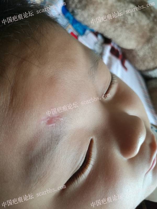 宝宝摔伤抗疤一年多的历程 抗疤,抗疤经历,抗疤护理,抗疤心得,儿童抗疤痕