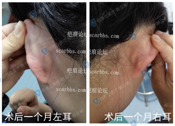 耳部疤痕疙瘩手术切除后容易复发，是真的吗？ 耳部疤痕,手术切除,放疗