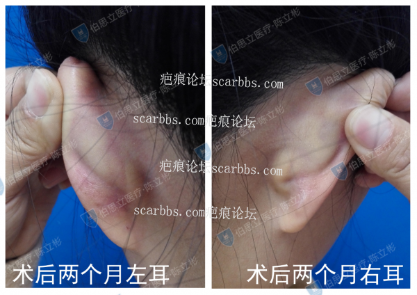 耳部疤痕疙瘩手术切除后容易复发，是真的吗？ 耳部疤痕,手术切除,放疗