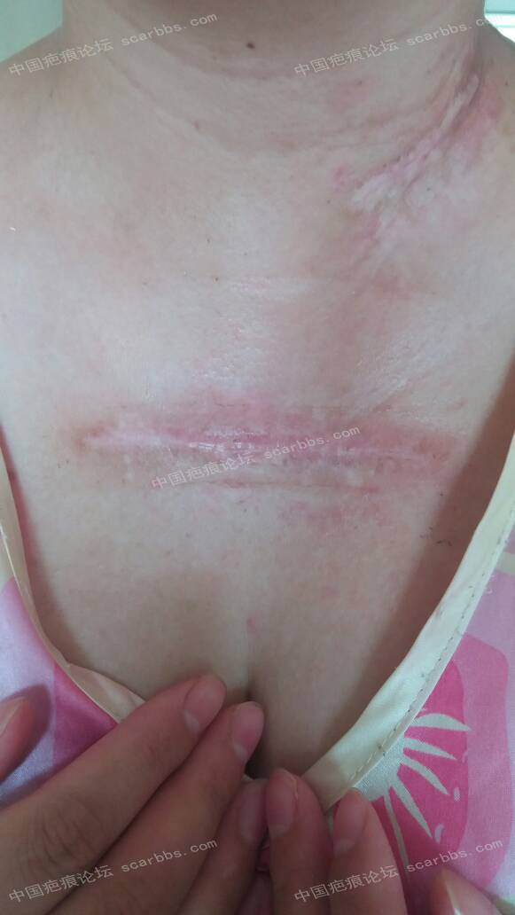 胸前疤痕疙瘩治疗前后 