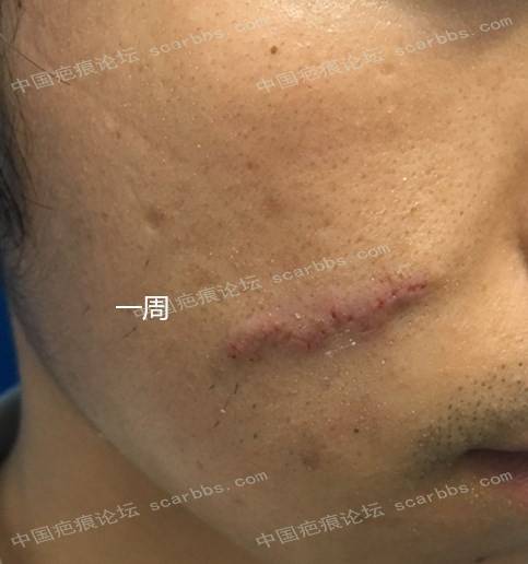 面部手术疤痕手术切除后记录 手术疤痕,记录