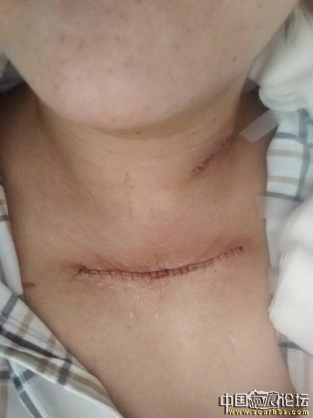 胸前疤痕疙瘩治疗前后 