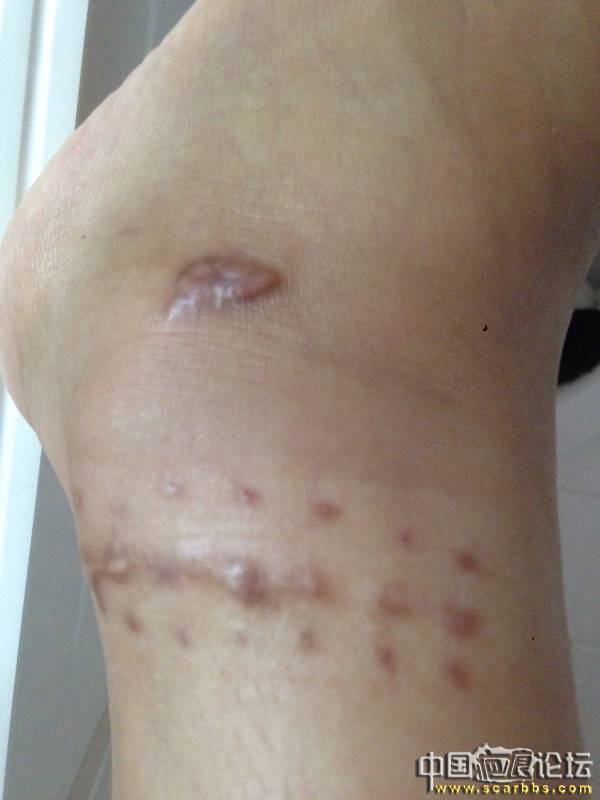 4月份的摔伤疤痕，记录我的祛疤过程 