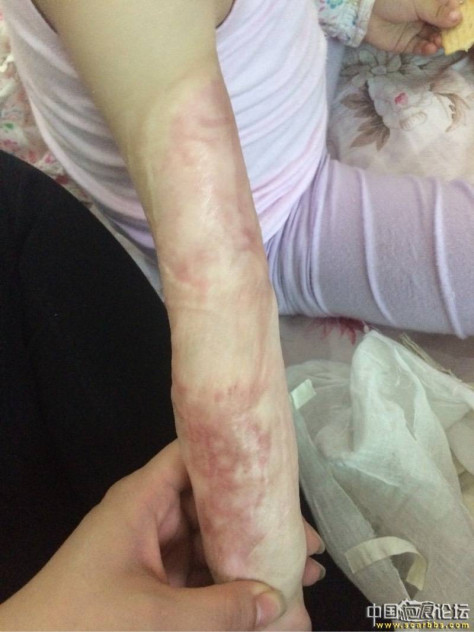 宝宝手臂抗疤10个月，大家看看 烧烫伤疤痕,手臂烫伤,胳膊烫伤