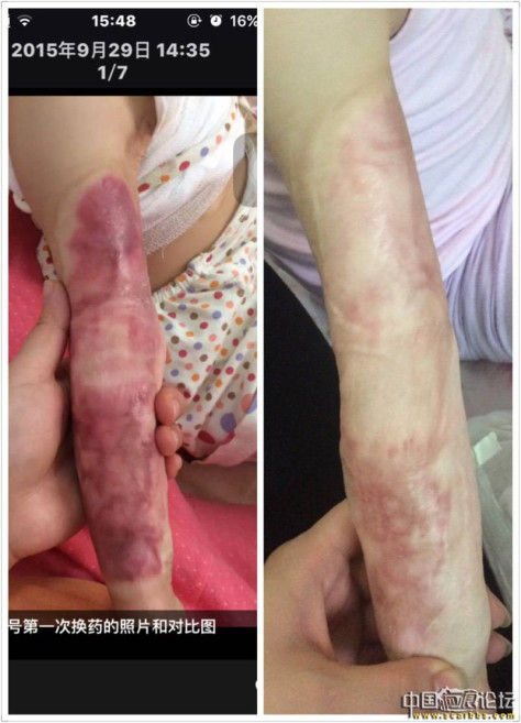 宝宝手臂抗疤10个月，大家看看 烧烫伤疤痕,手臂烫伤,胳膊烫伤