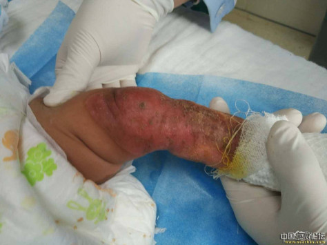 李高令2016年接治又一个先天性皮肤缺损的孩子（湖北恩施） 