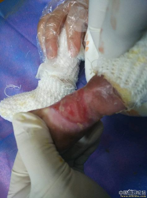 李高令2016年接治又一个先天性皮肤缺损的孩子（湖北恩施） 