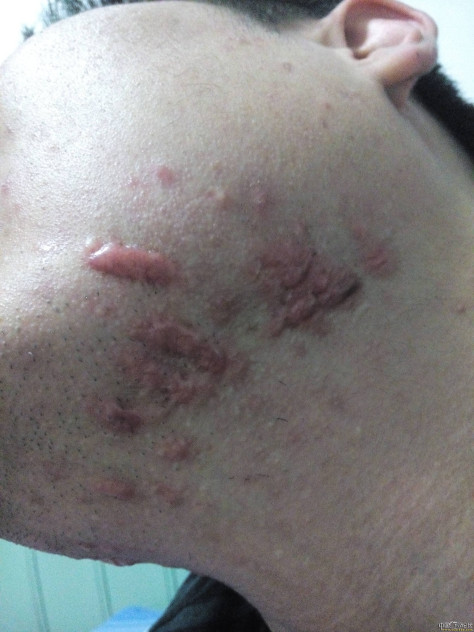 陪伴4年的腮部疤痕疙瘩治疗效果分享 腮部疤痕,疤康