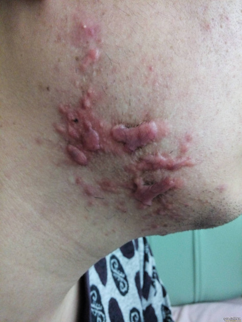 陪伴4年的腮部疤痕疙瘩治疗效果分享 腮部疤痕,疤康