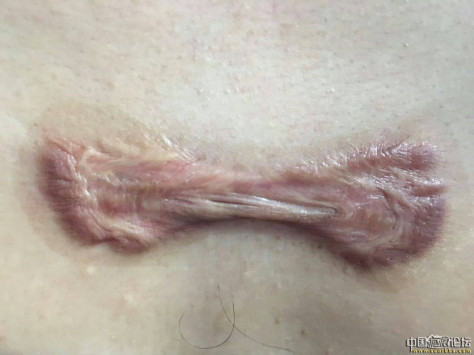 胸脯长毛囊炎形成疤痕疙瘩，已经在疤康治疗 