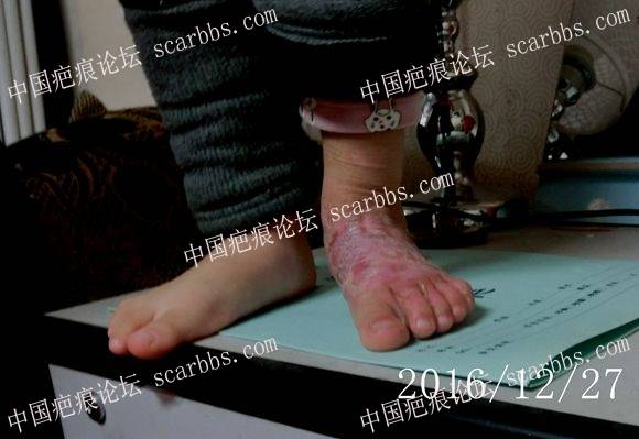 我倒要看看你杜佐胜有啥本事（女儿治疗脚部疤痕增生挛缩记录）17页北京疤康治疗更新 