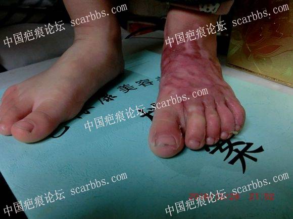我倒要看看你杜佐胜有啥本事（女儿治疗脚部疤痕增生挛缩记录）17页北京疤康治疗更新 