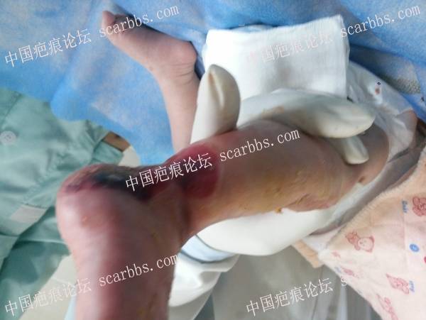 李高令2016年又接治一例新生儿先天性皮肤缺损孩子（河北） 