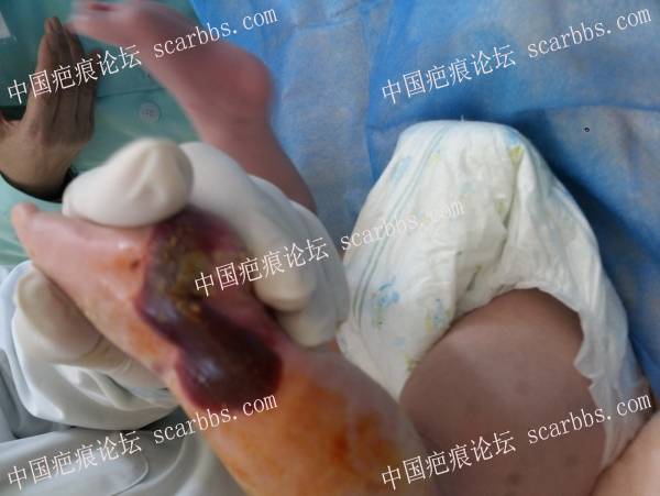 李高令2016年又接治一例新生儿先天性皮肤缺损孩子（河北） 