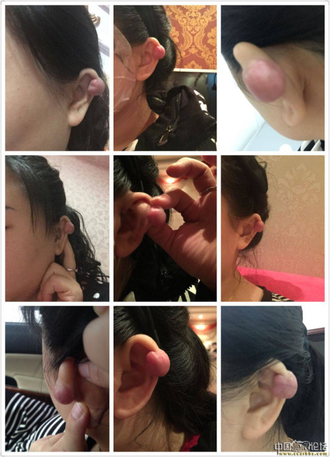 耳廓疙瘩治疗恢复完美