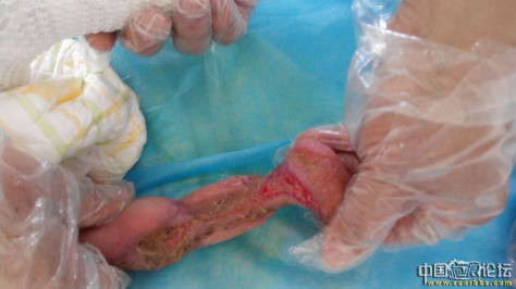 李高令2015年接治第一例新生儿先天性皮肤缺损孩子(湖北) 