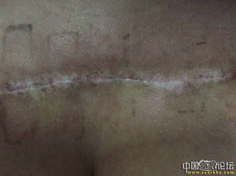 九院武晓莉，胸前疤痕疙瘩手术后一个月零十天了！ 