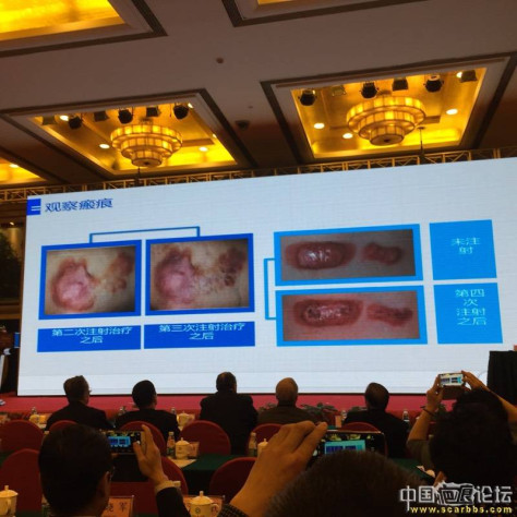 全程报道瘢痕医学分会第一届学术大会（回帖有礼） 