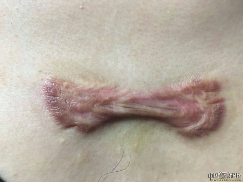 胸脯长毛囊炎形成疤痕疙瘩，已经在疤康治疗 