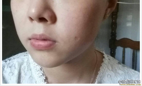 小时候的脸上的点痣疤痕，有什么治疗方法? 
