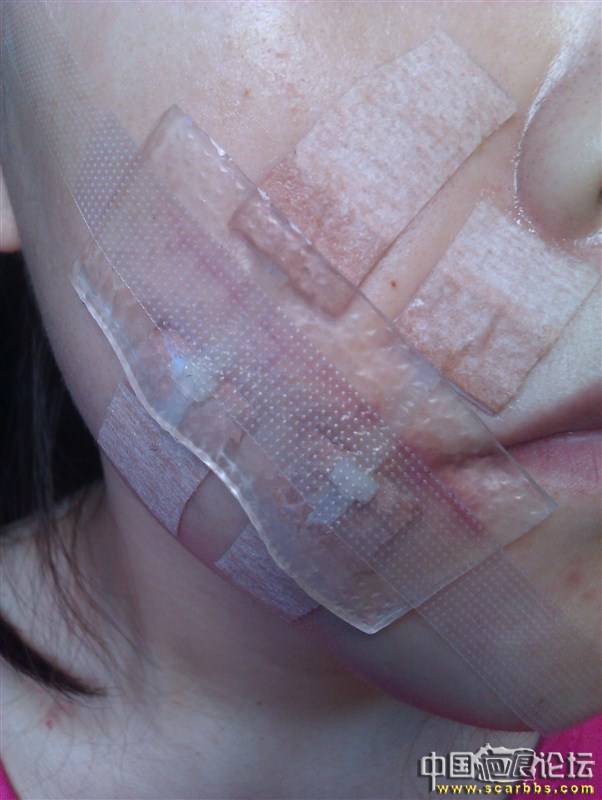 脸上的疤痕，确实很要命的说，上个月做的切除术，跟吧友们分享 