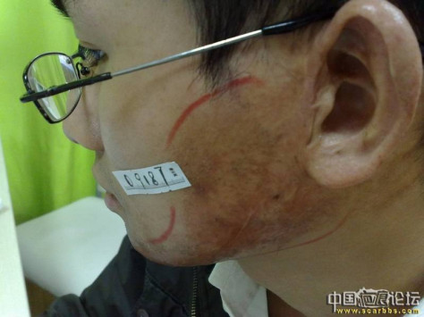 刘医生请问的疤痕还有治愈的可能吗 